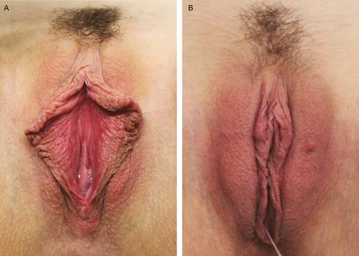 (A) Preoperative photograph of a 28-year-old woman. (B) Twelve-month postoperative photograph of the same patient after the injection of 20 mL of fat in each labium majus and wedge ressection of the labia minora.