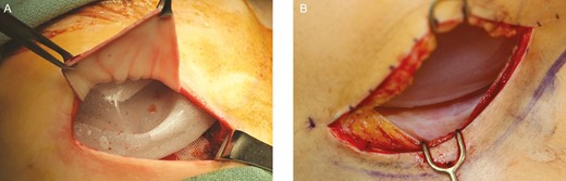 The intraoperative appearance of a smooth tissue expander with tab fixation and ADM inferolateral sling coverage. (A) Intraoperative appearance of the scar capsule of the smooth tissue expander is demonstrated (B) at 3 months at time of exchange to permanent implant.