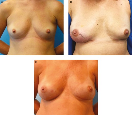 Infection in a smooth tissue expander. This 37-year-old female presented with a gene mutation, for which she desired bilateral prophylactic nipple-sparing mastectomies. (A) She underwent immediate breast reconstruction with subpectoral Sientra AlloX2 smooth tissue expanders with Alloderm RTU sling. (B) Two weeks postoperatively, she presented with right breast cellulitis and swelling accompanied with pain, generalized fatigue, and low-grade fever. She was admitted for IV Vancomycin and Cefepime. An integrated drainage port of her tissue expander was used to aspirate a small amount of fluid that later yielded methicillin-resistant Staphylococcus aureus. Her cellulitis resolved with 48 hours of therapy and she was treated with injection of 20 cc of Vancomycin into her peri prosthetic space via integrated tissue expander drainage port. This was repeated 5 times over the following 2 weeks. Three weeks following her admission to the hospital, her tissue expanders were exchanged for permanent silicone implants, and capsule culture taken at time of exchange was negative for methicillin-resistant S. aureus. (C) She remains without complications at 1 year from last surgery.