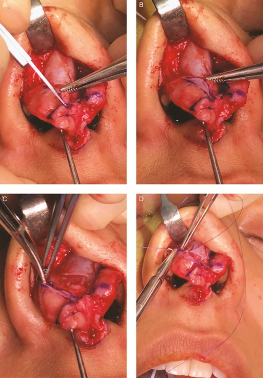 A demonstration of Ozmen et al’s technique on a 25-year-old female patient. (A) After domal creation with lateral crural steal, it is determined that the volume of the lateral crura must be further decreased. An incision is made 8 mm cephalic to the caudal border of the lower lateral cartilage. (B) The remaining cephalic cartilage is distracted cephalically while maintaining the longitudinal scroll ligament. (C) Scissor dissection is used to undermine the remaining lateral crura, helping to break the existing concavity/convexity and to create space for the cephalic portion to be “slid” under. (D) Sutures are used to attach and “sandwich” the 2 pieces of cartilage, making sure the knots are underneath the cartilage.