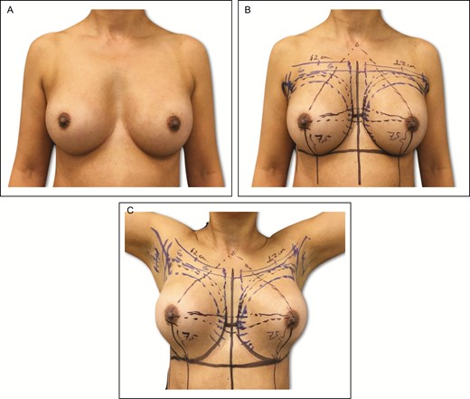 (A-C) Preoperative markings on 45-year-old female patient with a previous history of subfascial breast augmentation via the transaxillary approach 12 years previously. In this same patient, these skin marks include current symmetric inframammary fold, lateral limit of the pocket, represented by the anterior axillary line, midsternal line, and parasternal lines, with an average distance of 2 to 3 cm between the breasts.