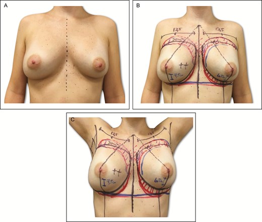 (A-C) Preoperative markings on 34-year-old female patient with previous history of submuscular breast augmentation via the transaxillary approach 15 years previously. In this same patient, similar markings associated with the preliminary area of autogenous fat grafting located on the upper and middle breast areas and intramammary fold asymmetry.
