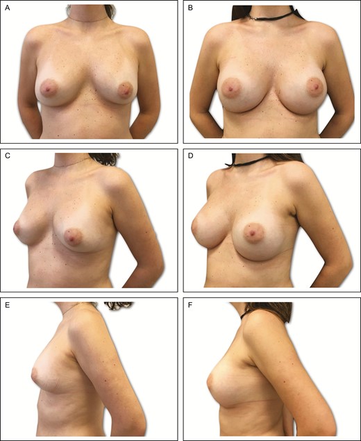 Preoperative (A) frontal, (C) left oblique, and (E) lateral views of a 34-year-old female patient with previous history of submuscular breast augmentation via the transaxillary approach 15 years previously. Presence of asymmetric intramammary folds, with a pinch test of 2 cm. (B, D, F) Appearance 2 years postprocedure in this patient, showing very good outcome with bilateral 335-cc Motiva SmoothSilk Surface Ergonomix implants, associated with 95 and 105 mL of autogenous fat grafting on the upper and upper-medial poles.