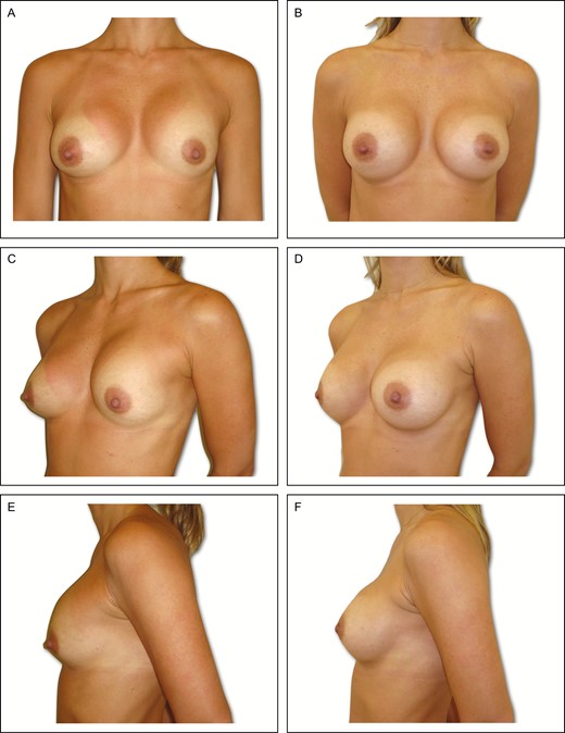Preoperative (A) frontal, (C) left oblique, and (E) lateral views of a 34-year-old female patient with previous history of subglandular breast augmentation via the transaxillary approach 9 years previously. Presence of asymmetric intramammary folds, with Baker grade IV capsular contracture on the left side and Baker grade II on the right side, with a pinch test of 3 cm. (B, D, F) Appearance 6 years postoperative in this patient, showing very good outcome with bilateral 295-cc Allergan 410 implants.