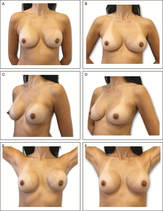 Preoperative (A) frontal, (C) left oblique, and (E) lateral views of a 36-year-old female patient with previous history of subfascial breast augmentation via the transaxillary approach 1 year before. The patient presented a left-side hematoma followed by Baker grade III capsular contracture on the same side. Presence of asymmetric intramammary folds and pinch test of 3 cm. (B, D, F) Appearance 1 year postprocedure showing very good outcome in this patient, with the same left implant (295-cc Motiva SmoothSilk Surface Ergonomix).