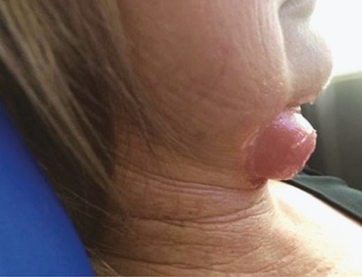 Photograph of this 37-year-old female showing the immediate posttreatment appearance. The posttreatment swelling lasted for 2 minutes and the massage process rewarms and reshapes the tissue.