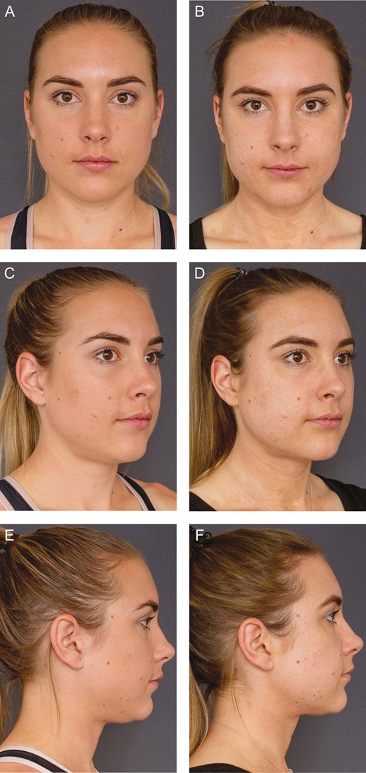 (A, C, E) Pretreatment and (B, D, F) 6-week posttreatment photographs of this 27-year-old female (the same patient featured in Figures 2 and 3).
