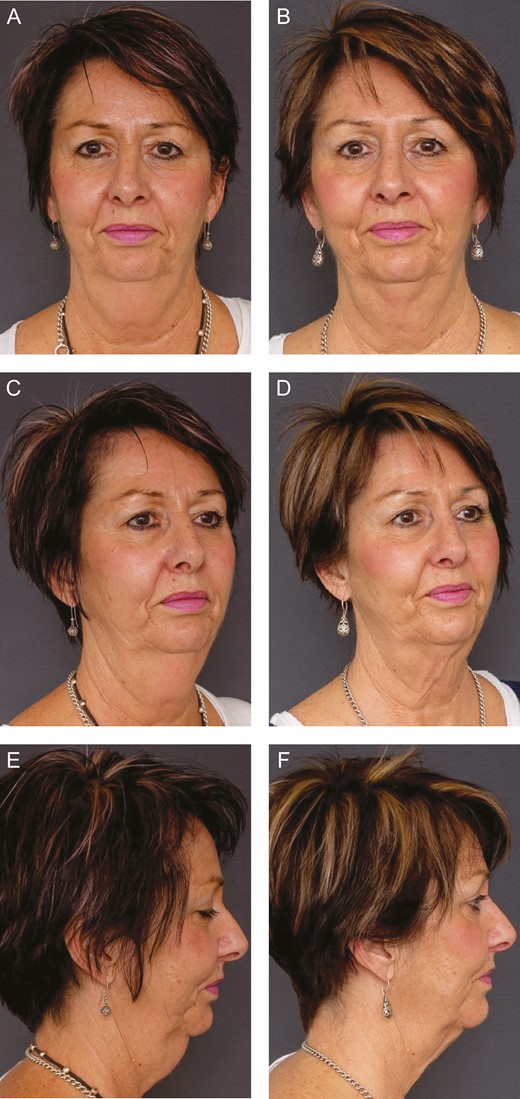 (A, C, E) Pretreatment and (B, D, F) 12-week posttreatment photographs of this 60-year-old female.