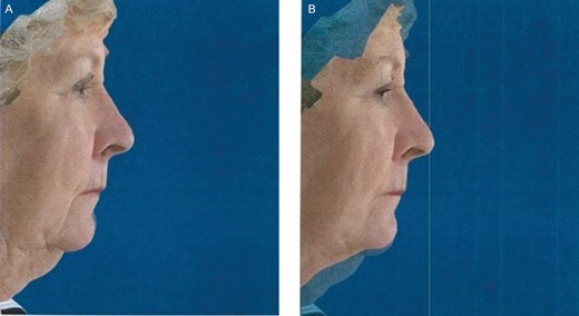 (A) Pretreatment lateral image of this 71-year-old female. (B) Superimposed image at 12 weeks posttreatment displaying the difference in reduction posttreatment.