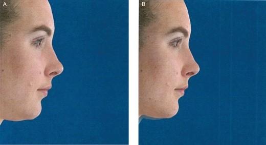 (A) Pretreatment lateral image of this 27-year-old female. (B) Superimposed image at 12 weeks posttreatment displaying the difference in reduction posttreatment.