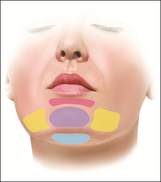 Schematic representation of treatment sites. Sublabial crease (pink), pogonion (purple), mentum (blue), and prejowl sulci (yellow).