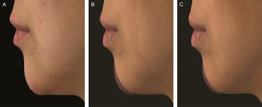 Photographs of a 33-year-old Asian woman demonstrating Volux chin treatment at baseline (A), and silhouetted with her baseline profile at month 3 (B) and month 18 (C). The glabella-subnasale-pogonion angle was 161.8° at screening (A), 164.9° at month 3 (B), and 166.1° at month 18 following initial Volux treatment of 1.70 mL, and 167.3° at month 1 of repeat Volux treatment of 2.20 mL. This subject did not receive top-up treatment.