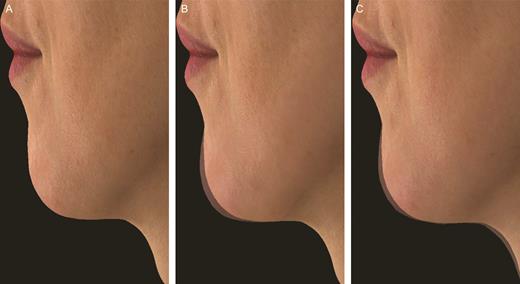 Photographs of a 43-year-old Caucasian woman demonstrating Volux chin treatment at baseline (A), and silhouetted with her baseline profile at month 3 (B) and month 18 (C). The glabella-subnasale-pogonion angle was 161.5° at screening (A), 163.1° at month 3 (B), and 163.5° at month 18 (C) following initial and top-up Volux treatment of 1.00 and 0.80 mL, respectively. This subject did not receive repeat Volux treatment, and her glabella-subnasale-pogonion angle was 162.8° at month 24 (not shown).