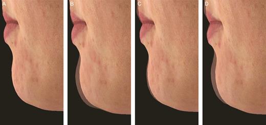 Photographs of a 27-year-old Caucasian woman demonstrating Volux chin treatment at baseline (A), silhouetted with her baseline profile at month 3 (B) and month 18 (C) following initial treatment, and at month 1 following repeat treatment (D). The glabella-subnasale-pogonion angle was 163.9° at screening (A), 167.6° at month 3 (B), and 165.4° at month 18 following initial and top-up Volux treatments of 2.00 mL (each), and 168.7° at month 1 of repeat Volux treatment of 1.40 mL.