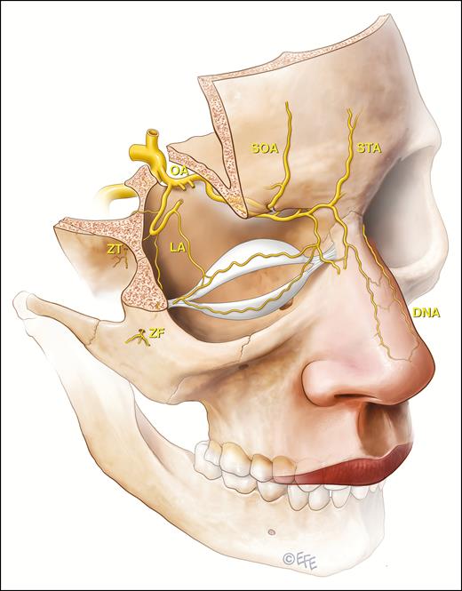 The ophthalmic artery system arises from the internal carotid artery and the danger zones are associated with the end vessels that supply facial tissues or via anastomotic connections of the external carotid system with the ophthalmic end vasculature. The ophthalmic artery (OA) end vessels are the supraorbital (SOA), supratrochlear (STA), dorsal nasal artery (DNA), and lesser recognized zygomaticofacial (ZF) and zygomaticotemporal (ZT) that both arise from the lacrimal artery (LA). Not demonstrated on this illustration and with unknown relevance to filler induced blindness is the anterior ethmoidal artery, which has a terminal cutaneous branch, the anterior nasal artery. This vessel enters the nasal dorsum between the nasal bone and upper lateral cartilage.