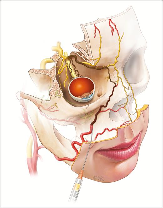 It is presumed that injectable filling agents may cause blindness if a column of filler is pushed against the prevailing arterial blood pressure of the ophthalmic artery and gains access to the central retinal arterial system and/or the ciliary vessels. An embolus is carried forward by the usual direction of flow on release of the plunger. The locations of greatest risk appear to be the forehead, glabella, and nasal dorsum. The nasolabial fold region is the area of next greatest risk.