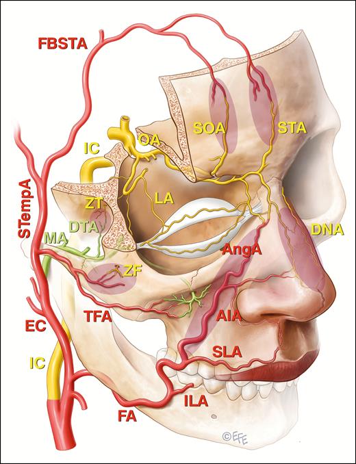 The communications between the external carotid system and the end branches of the ophthalmic artery (OA) that are implicated in filler induced blindness are shaded. These include the angular branch (AngA) of the facial artery (FA), the transverse facial artery (TFA) arising from the superficial temporal artery (STempA), and the deep temporal branch (DTA) of the maxillary artery (MA) in shaded zones as indicated. The frontal branches of the superficial temporal artery (FBSTA) pass anteriorly into the forehead and will eventually anastomose with the supraorbital (SOA) and supratrochlear arteries (STA), but the FBSTA have not been directly implicated in blindness following filler injections. Other vessels indicated are internal carotid artery (IC), external carotid artery (EC), inferior labial artery (ILA), superior labial artery (SLA), inferior alar artery (AIA), dorsal nasal artery (DNA), zygomaticofacial artery (ZF), zygomaticotemporal artery (ZT), and lacrimal artery (LA).