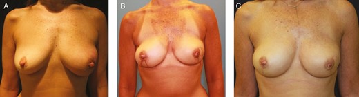 This 49-year old female patient with recurrent left breast cancer after lumpectomy and radiation underwent bilateral nipple-sparing mastectomy with autologous lateral thigh perforator flap reconstructions. Patient is shown (A) preoperatively, (B) 3 months postoperatively after immediate lateral thigh perforator flap reconstruction through vertical mastectomy incisions, and (C) 1 year after initial reconstruction now after skin paddle excision and 1 session of autologous fat transfer to bilateral breasts.