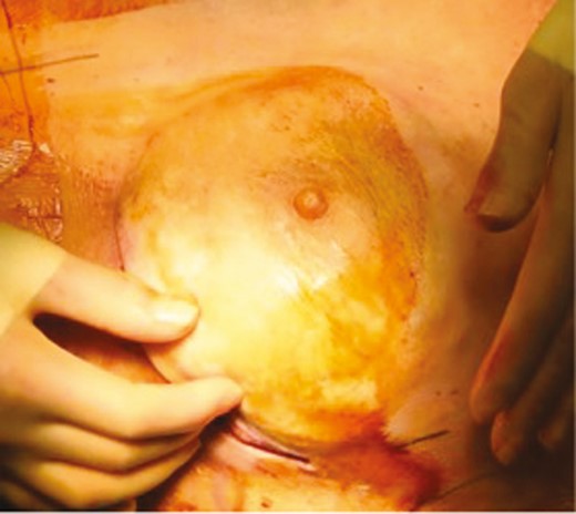 Intraoperative photograph (patient age unknown) demonstrating redraping of the mastectomy flap over the implant in a case of immediate implant reconstruction and nipple-sparing mastectomy. Note that the nipple-areola complex is optimally placed over the most projecting part of the reconstruction. The underside of the nipple may then be secured to the underlying muscle or scaffold to hold this position. This will maximize aesthetic results and minimize risk of postoperative nipple malposition.