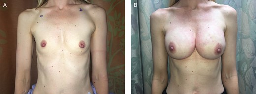 (A) A 42-year-old female presented with right breast cancer and a desire for bilateral nipple-sparing mastectomies. She desired a very large size postoperatively, and thus underwent bilateral prepectoral tissue expander placement. At the second stage, the expanders were exchanged for round cohesive silicone gel implants. (B) At 2 years postoperatively, she maintains a stable, soft breast reconstruction on each side.