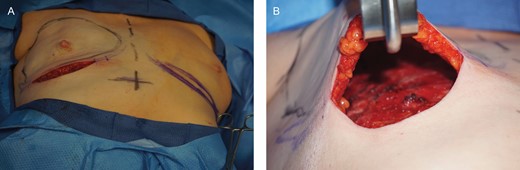 (A) A 48-year-old female presented with left breast cancer, and underwent a 2-stage expander-based prepectoral breast reconstruction on the left breast, and a right breast augmentation for symmetry. (B) After mastectomy was completed, mastectomy flaps were assessed and deemed to be adequate.