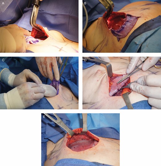 (A-E) ADM was used to hold the tissue expander in the prepectoral pocket.
