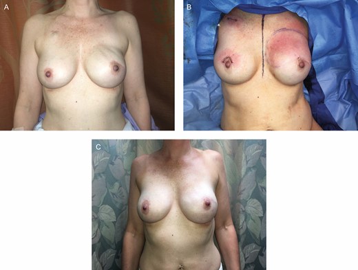 (A) After completion of reconstruction, the patient had notable rippling and upper pole implant visibility on the left reconstruction breast. (B) She underwent a third-stage procedure, where fat grafting alone was performed to the left breast reconstruction in the upper pole skin flaps (90 mL). (C) Another 9 months following this revision with left breast fat grafting, there is complete correction of the left breast rippling. This highlights the importance of autologous fat grafting in prepectoral patients, which is routinely done by the authors at the second-stage expander-to-implant exchange operation.
