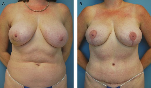 (A) Preoperative photograph of this 51-year-old female with right breast cancer who underwent right mastectomy and immediate right deep inferior epigastric perforator flap breast reconstruction followed by a left mastopexy and a right breast flap revision for symmetry. (B) The final photograph displays her 10-month postoperative result.