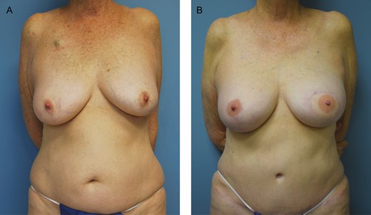 (A) Preoperative photograph of this 63-year-old female with left breast cancer who underwent left mastectomy and tissue expander placement followed by radiation therapy. She then underwent a delayed neurotized stacked deep inferior epigastric perforator flap reconstruction followed by a left breast flap revision and right mastopexy for symmetry. (B) The final photograph displays her 11-month postoperative result.