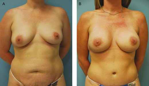 (A) Preoperative photograph of this 31-year-old female with a strong family history of breast cancer and a positive BRCA mutation who underwent bilateral mastectomies and immediate bilateral deep inferior epigastric perforator flap reconstruction followed by a bilateral breast flap revision and bilateral implant placement for additional volume and projection. (B) The final photograph displays her 1-year postoperative result.