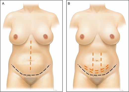 (A) Diagram of the ideal abdominal scar position (black line) for deep inferior epigastric perforator flap donor site closure and the location for the plication sutures (orange line) in patients with significant rectus diastasis. (B) Location of the progression tension sutures between the abdominal wall and the abdominal flap and along the inferior incision (orange line).