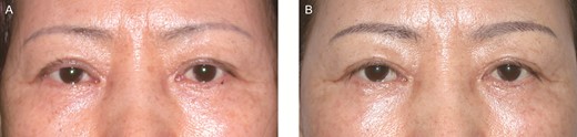 (A) Preoperative view of a dry eye case with involutional ectropion in this 66-year-old female patient. (B) Postoperative view at 1 year after tarsal scoring incision. The ectropion was successfully corrected, and dry eye symptoms were also resolved.