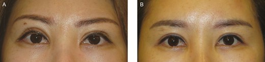 (A) Preoperative view of this 39-year-old woman who complained of asymmetric high fold with dry eye symptoms after previous upper blepharoplasty. The high fold is usually combined with a deep fold because of excessive upward pulling of the pretarsal composite flap. This deep fold may result in ectropion and eyelash eversion. The gray line is observed below the eyeline tattoo line. (B) Postoperative view 1 year after the tarsal scoring procedure. The everted eyelid margin had turned inward, and the gray line had returned to its normal position such that the tattoo line is placed on the lowest eyelid margin. Accordingly, the everted and upturned eyelashes were directed downward. Downward-directed upper eyelid lashes are normal in many Asian patients but are often considered abnormal in Caucasian patients.