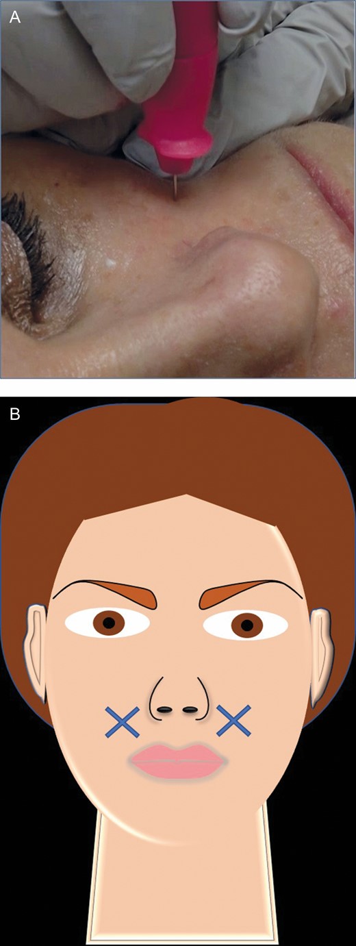 (A) Microbiopsy extraction procedure. The tip of the biopsy punch is inserted directly perpendicular to the patient’s skin, this 55-year-old female. (B) The Xs in the artwork depict the facial biopsy locations, 2 cm from the left and right alar bases.