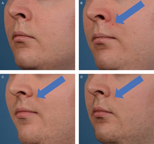 Photo progression of the biopsy site healing on this 26-year-old male. Photographs were taken immediately before biopsy (A), 1 minute post-biopsy (B), 1 month post-biopsy (C), and 3 months post-biopsy (D).