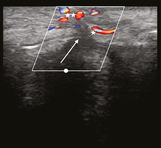 Complete occlusion. Turbulence is found proximal to the blocking agent. Collateral vessels increase in diameter, leading to a particular duplex ultrasound image, resembling a “Medusa head” (asterisk).