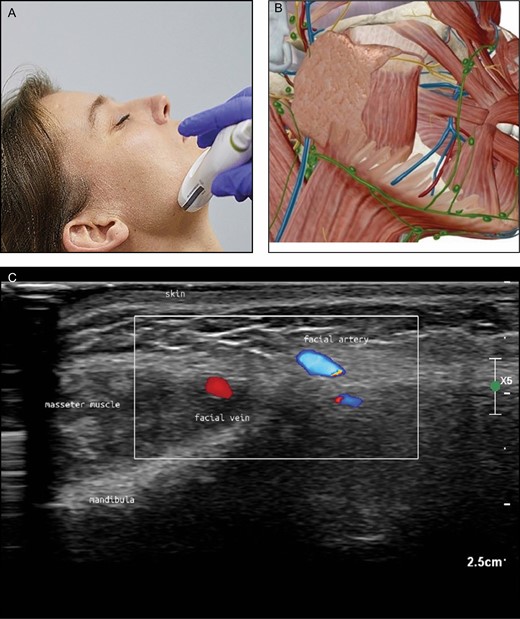 (A) Position of the probe on jawline. Female model; age, 39 years. (B) Anatomic overview of the structures visible in the ultrasound image Figure 2C. (C) Position 1: jawline. The facial vein (V) is ventral (medial) to the masseter muscle and the facial artery (A) is more ventral (medial) than the vein. The different colors are artifacts produced by the ultrasound device because of the rapid blood flow in the vessel (alienation).
