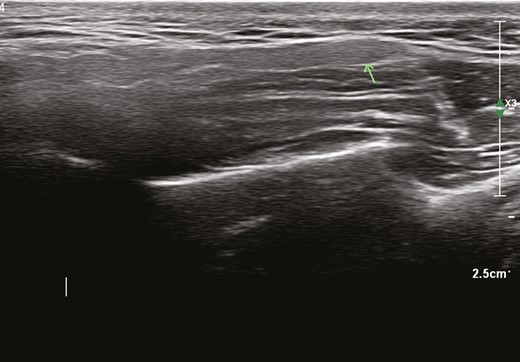 Homogeneous fine granular hypoechoic structure (arrow: parotid gland) on top of masseter muscle.
