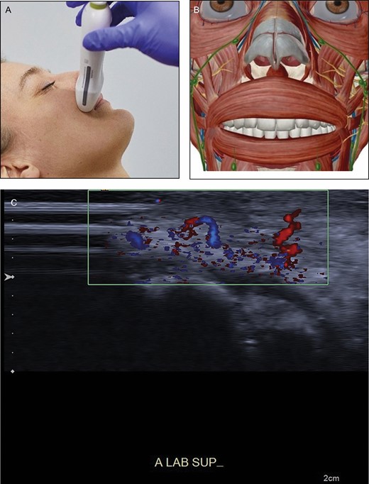 (A) Position of the probe on upper lip. Female model; age, 39 years. (B) Anatomic overview of the structures visible in ultrasound image. (C) Position 3: upper lip. A tortuous superior labial artery is running both superficial and deep to the orbicularis oris muscle (asterisk), resembling a “dancing snake.” In the blue parts the blood streams away from the probe; in the red part the blood streams towards the probe. Teeth are visible (double asterisk).