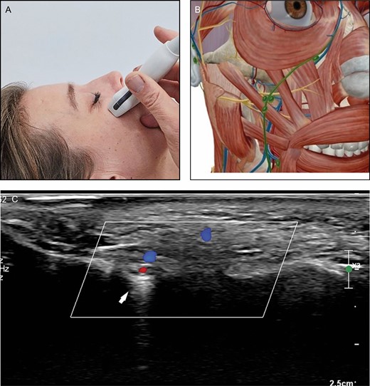 (A) Position of the probe on midface. Female model; age, 39 years. (B) Anatomic overview of the structures visible in ultrasound image. (C) Position 4: midface. The infraorbital artery enters the midface area through the infraorbital foramen (arrow).