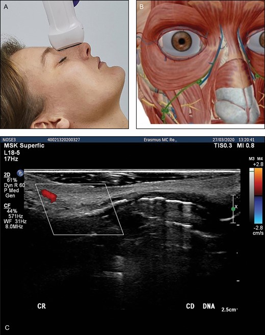 (A) Position of the probe on nose. Female model; age, 39 years. (B) Anatomic overview of the structures visible in ultrasound image. (C) Position 5: nose. Transverse position of the probe. DNA, dorsal nasal artery.