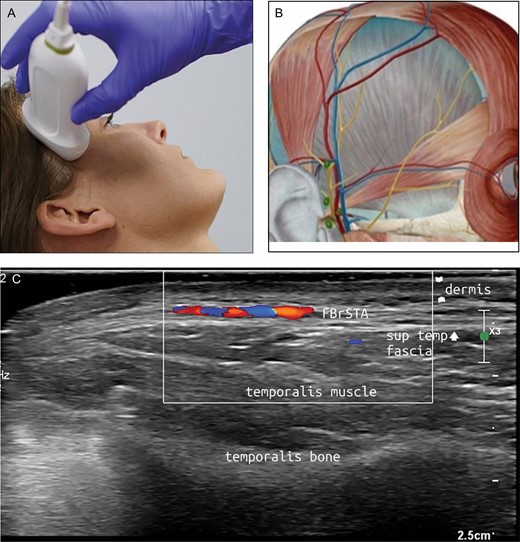 (A) Position of the probe on temporal area. Female model; age, 39 years. (B) Anatomic overview of the structures visible in ultrasound image. (C) Position 6: temporal area. FBrSTA, the frontal branch of the superficial temporal artery between the superficial and deep temporal fascia.