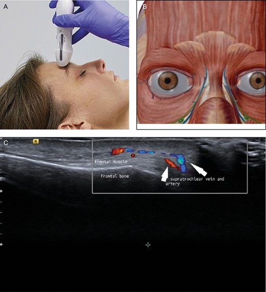 (A) Position of the probe on forehead. Female model; age, 39 years. (B) Anatomic overview of the structures visible in ultrasound image. (C) Position 7: forehead. The supraorbital artery runs above the corrugator muscle.