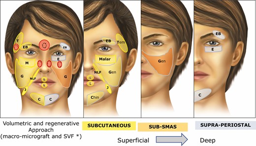 (A) The “Regen Fat Code” facial system protocol was adopted as a guide to facial lipotransfer, considering the volumetric and regenerative approaches (area, plane, cannula, particle size, and SVF enrichment). For example, “C” indicates chin; grey and yellow indicate supraperiosteal and subcutaneous planes, respectively; uppercase letters indicate macrograft (volumetric approach) and lowercase letters indicate micrograft. In cases where the regenerative approach is demanded, the microfat is supplemented with SVF. Danger areas (red circle) must be handled carefully to avoid vascular phenomena, with use of the of 2% lidocaine with epinephrine to promote local vasoconstriction, as well as a blunt cannula to reach the safety plane in retrograde injection mode. The lipotransfer is addressed from the superficial to the deepest plane in the face. (B) Subcutaneous approach. (C) Sub-superficial muscular aponeurotic system approach. (D) Supraperiosteal approach. All the anatomic areas shown in the figure may receive micrograft. In this case, the letter would be in lowercase, as t (temporal), eb (eyebrow), e (eyelid), m (malar), g (genian region), nlf (nasolabial fold), j (jowl), l (lip), c (chin). In the case that lipotransfer is associated with SFV-enriched fat, it is placed in the subdermal layer. An example: m-1-yellow* (m, malar; lowercase letters, micrograft + SFV-enriched fat; 1, 1 mm cannula; yellow, subcutaneous/subdermal). SVF, stromal vascular fraction; SMAS, superficial muscular aponeurotic system.