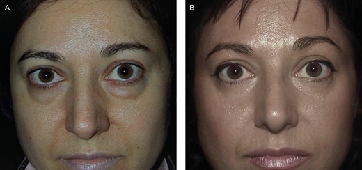 (A) Preoperative photograph of a Group A female patient, 43 years old, who underwent lipotransfer in the tear trough in the subperiosteal layer. (B) Postoperative photograph (1 year), showing great improvement in the tear trough and the disappearance of the swollen aspect of the lower eyelids.