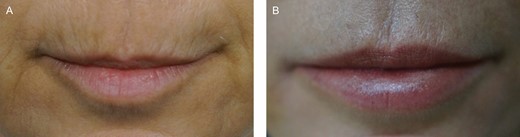 (A) Preoperative photograph of a Group B female patient, 45 years old, who underwent macrograft and SVF-enriched micrograft in the perioral area and lips. (B) Postoperative photograph (1 year); the increase in skin quality is noticeable.