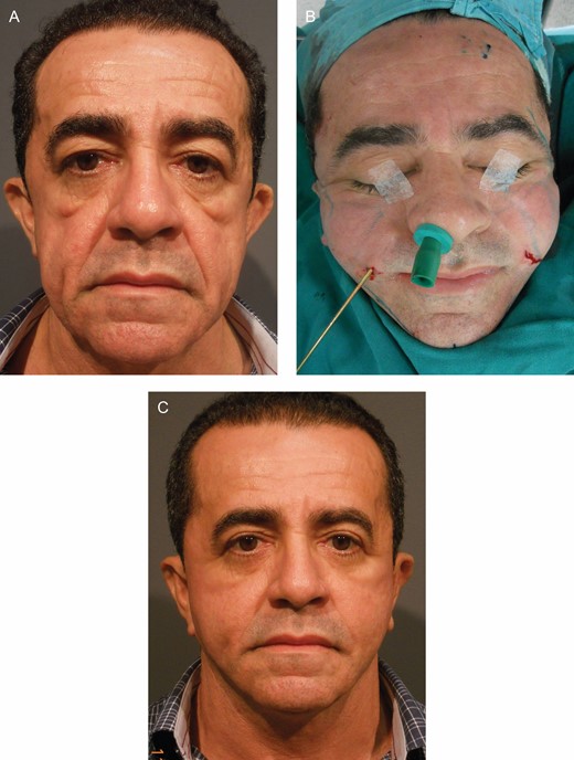 A male Group B patient, 51 years old, who undewent macro lipotransfer combined with face-lifting by the Regen Fat Codes protocol. (A) Preoperative, (B) during surgery, and (C) 1 year postoperative.