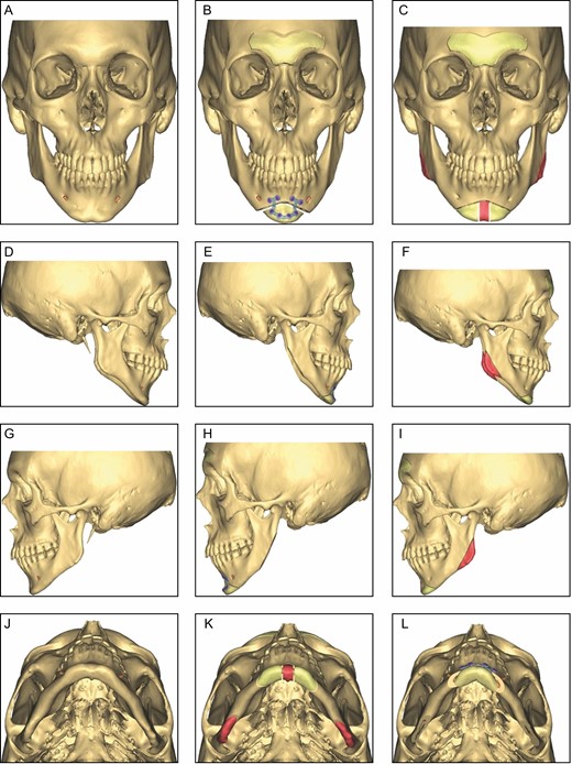 Three-dimensional virtual surgical planning. Preoperative anatomy (A, D, G, J). Osteotomy lines and osseous resection bands (in red) are determined based on the preoperative planning (C, F, I, K). Virtual planning of the desired postoperative result in collaboration with the patient (B, E, H, L).