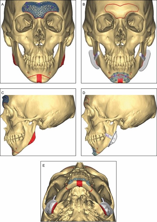 Custom surgical cutting guides for anterior frontal sinus setback (A, B), mandibular angle reduction, and genioplasty (C-E).