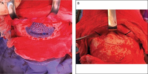 Custom cutting guide for anterior frontal sinus setback on this 43-year-old transgender patient who underwent male-to-female transition. (A) Osteotomy is performed with a sagittal saw following the guide osteotomy lines. (B) Supraorbital pedicles (black arrows) are respected.
